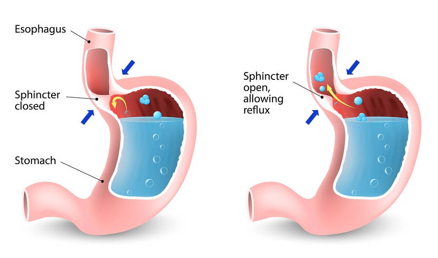 Acid reflux