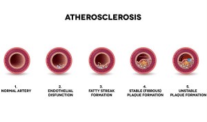 Atherosclerosis
